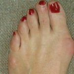 Bunions: Risks, Complications, and Treatment
