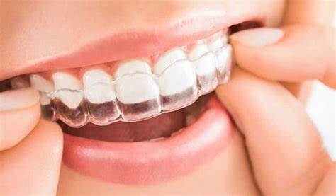 Dental Problems That Invisalign Can Fix