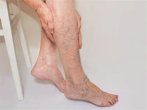 Varicose Veins Does Not Have to be a Problem