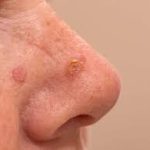 Here’s Everything You Need To Know About Actinic Keratosis