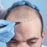 Benefits of FUE (follicular unit extraction)