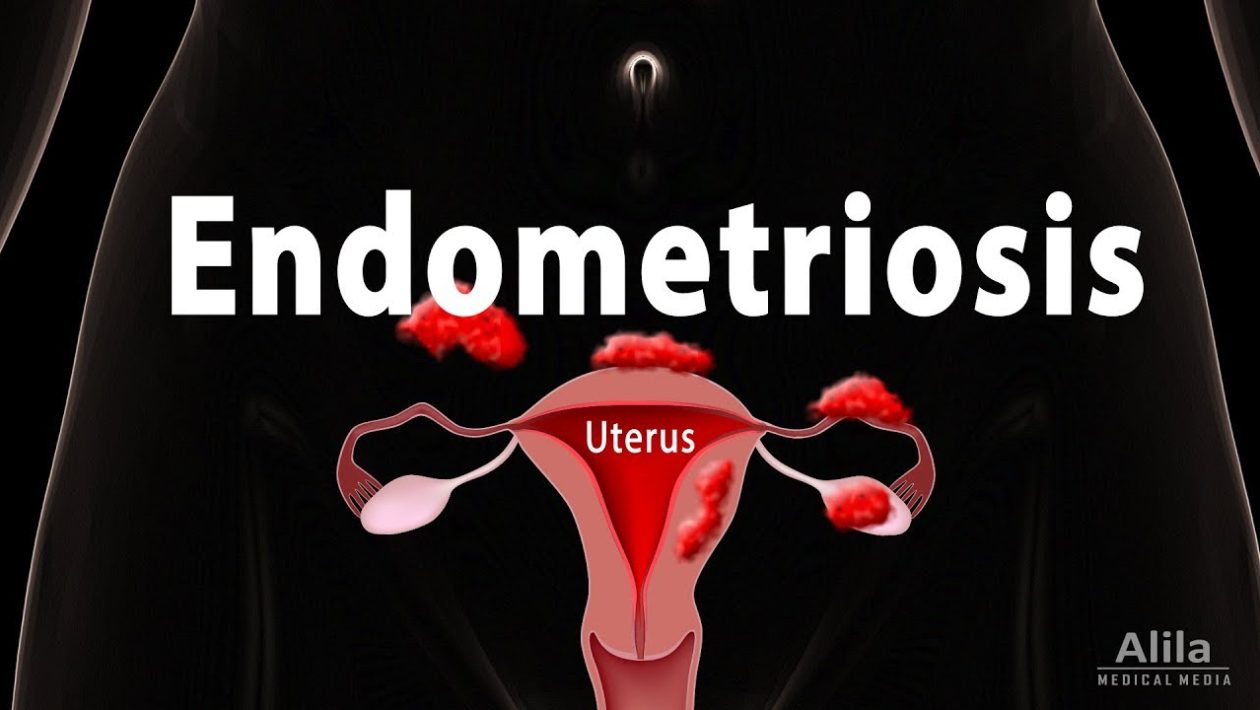 Factors for Endometriosis