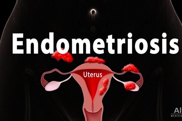 Factors for Endometriosis