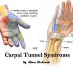 What You Need To Know About Carpal Tunnel Syndrome