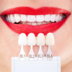 Uncovering the Top Myths Associated with Veneers