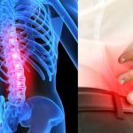 What You Need to Know About Spinal Stenosis