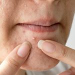 Acne; Types, Causes, and Treatments