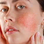 What Treatments Can Provide Long-term Relief for Rosacea Symptoms?