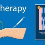 What You Should Expect During Treatment with Sclerotherapy